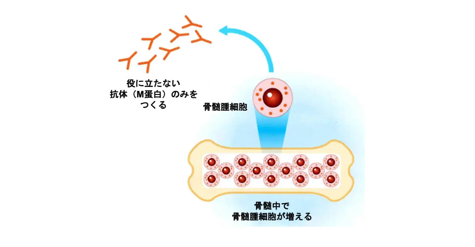 骨髄腫細胞の増殖とM蛋白の産生