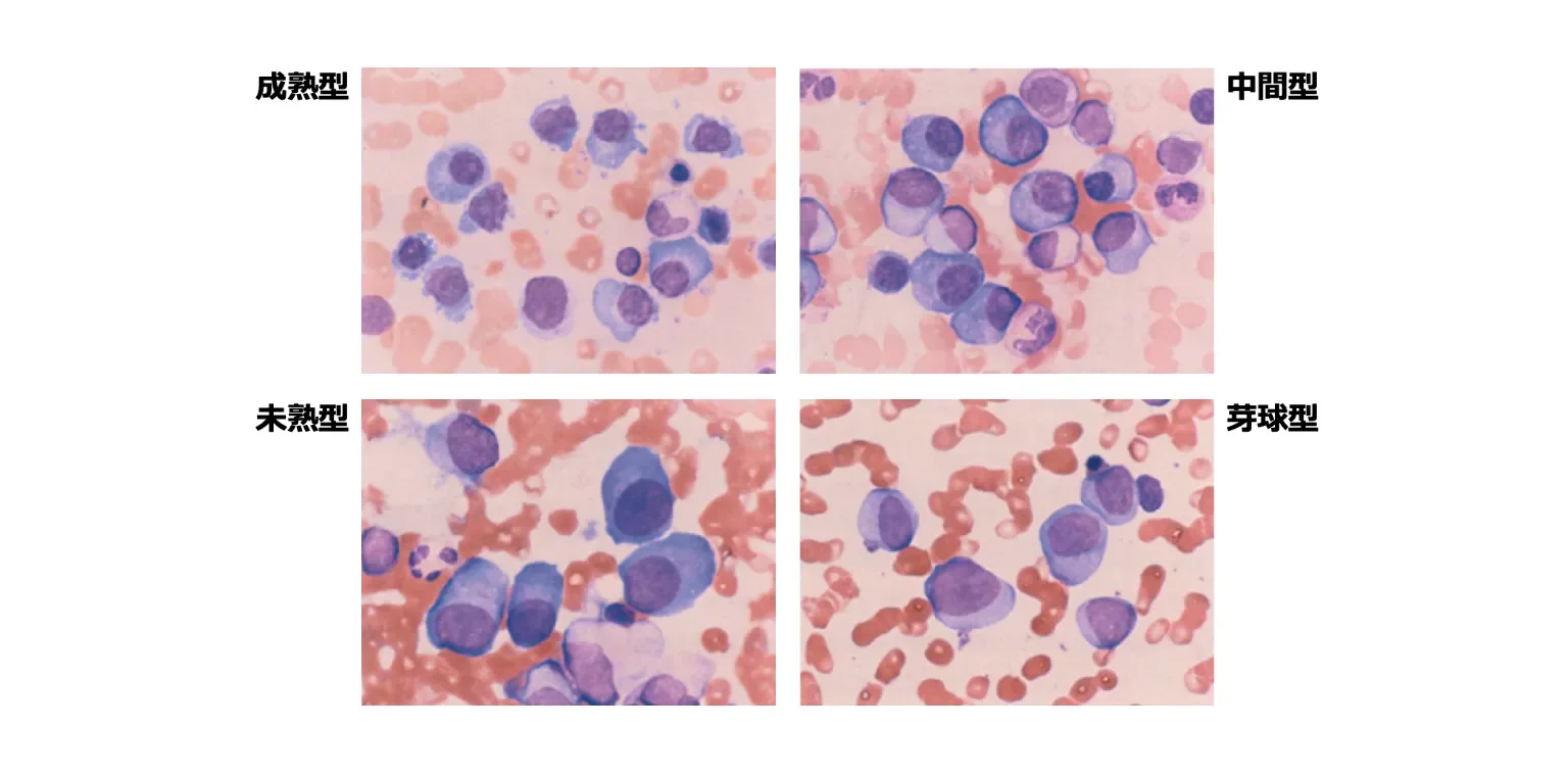  骨髄腫細胞の形態2)